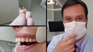 Dr Juliano Coura  O provisório perfeito para espera do Implante dentário [upl. by Hiasi]