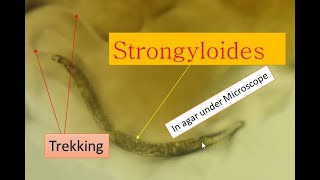 Strongyloidiasis cause and its pathogenesis Strongyloides under microscope [upl. by Vanni]