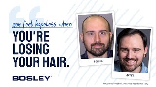 Bosley Hair Transplant Review  Luke K [upl. by Hillel]