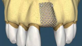 Implantes Dentários  Com Enxerto Ósseo [upl. by Anayd]