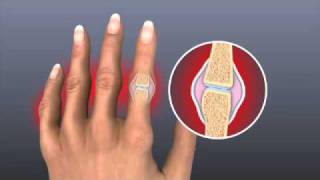 Rheumatoid Arthritis  Treatment  Johns Hopkins [upl. by Cynthea644]