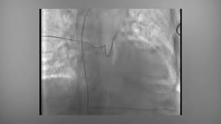 Fluoroscopic loop demonstrates axillary access [upl. by Ethbun]