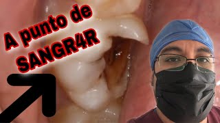 👄Caries CERCA del NERVIO 🚨 bases para protección pulpar💙 [upl. by Amairam302]