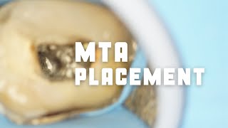 MTA placement in root canals  MTA apexification [upl. by Ailekat]