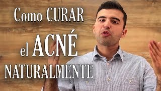 8 TIPS PARA CURAR EL ACNÉ  Niki Mayo [upl. by Nhguaved144]