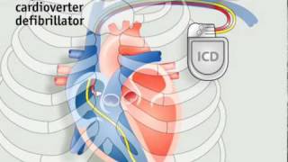 How pacemakers work [upl. by Narib95]