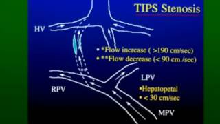 Doppler Evaluation of TIPS Shunts [upl. by Nodaj]