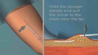 Jadelle insertion and removal Tutorial [upl. by Rabassa595]