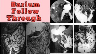 Barium Follow Through Complete Study [upl. by Ciredec]