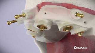 Implantes com Cirurgia Guiada [upl. by Aivek]