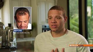 Bosley Hair Transplant Review  Troy P [upl. by Esyli]