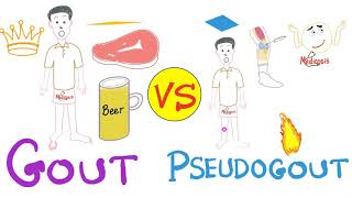 Gout vs Pseudogout  MSU vs CPPD disease  Rheumatology Series [upl. by Devol]