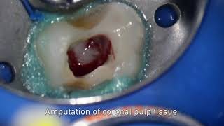 MTA pulpotomy – Video abstract ID 134315 [upl. by Hiram]