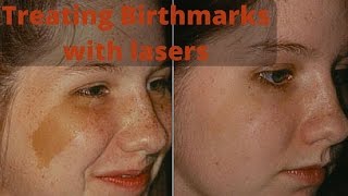 How to treat birthmarks [upl. by Asseram349]