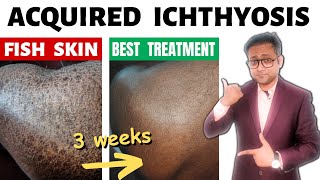 Acquired ichthyosis  Fish skin  Treatment  Hindi [upl. by Elyac]