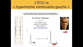 7a L’ECG de lhypertrophie ventriculaire gauche HVG Basic Dr Taboulet [upl. by Reta]