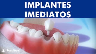 Implantes imediatos após a extração do dente © [upl. by Nifares]