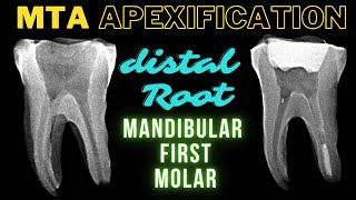 MTA APEXIFICATION  Mandibular First Molar  Apexification Step by Step [upl. by Gunas643]