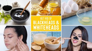 Easy Ways To Remove Blackheads And Whiteheads At Home [upl. by Humfried]