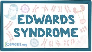 Myelodysplastic syndromes  causes symptoms diagnosis treatment pathology [upl. by Sadoc]