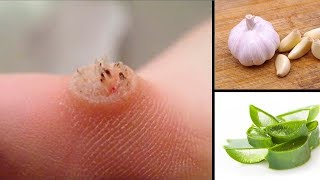 How To Remove Warts At Home Naturally [upl. by Drexler]