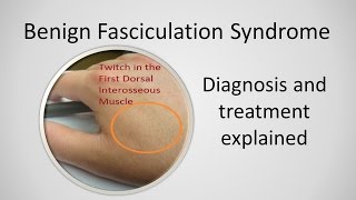 Benign Fasciculation Syndrome Causes and Treatment [upl. by Noret]