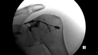 ORTHOMED Shoulder Injection under Fluoroscopic [upl. by Dagmar]