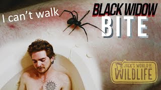 Black Widow BITE Try To SURVIVE [upl. by Sucramd]