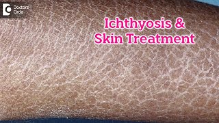 What is Ichthyosis How to Treat my Skin Fish like scales On SkinDrRasya Dixit  Doctors Circle [upl. by Latsyrhk]